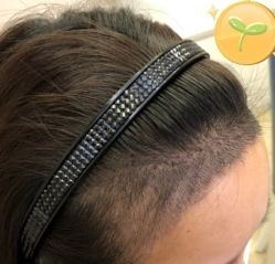 -大麦微针植发丨全国连锁