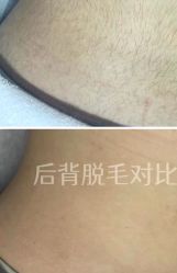 -薇兰专业脱毛连锁机构