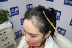 -大麦微针植发丨全国连锁