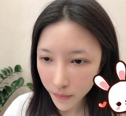 点击看大图 -大麦微针植发丨全国连锁