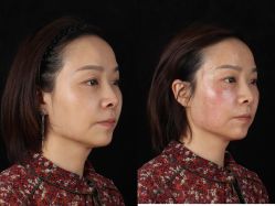 -杭州米兰柏羽医疗美容医院