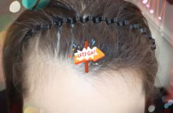 -大麦微针植发全国连锁