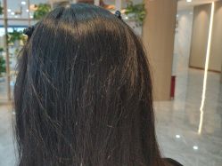 -碧莲盛·不剃发植发