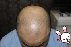 -大麦微针植发丨全国连锁