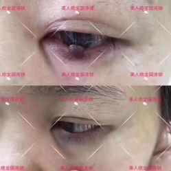 -美人痣全国连锁