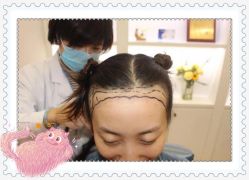 点击看大图 -大麦微针植发全国连锁