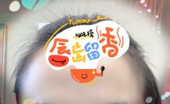 -大麦微针植发全国连锁