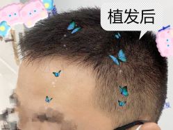 -大麦微针植发全国连锁