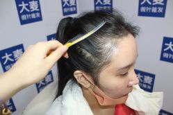 -大麦微针植发丨全国连锁
