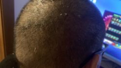 -大麦微针植发丨全国连锁