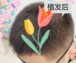 -大麦微针植发全国连锁