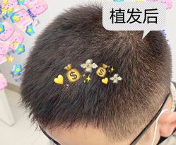 -大麦微针植发全国连锁