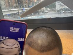 -碧莲盛·不剃发植发