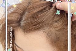 -大麦微针植发全国连锁