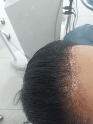 -大麦微针植发丨全国连锁