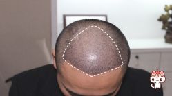 -大麦微针植发丨全国连锁