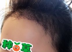 -大麦微针植发丨全国连锁