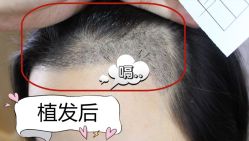 -大麦微针植发全国连锁