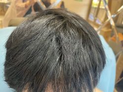 -碧莲盛·不剃发植发