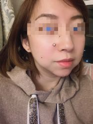 -北京美痣堂古方祛痣斑疣瘊