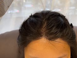 -碧莲盛·不剃发植发