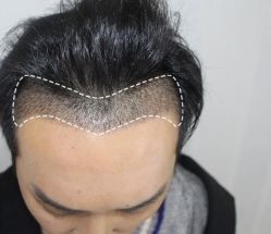 -大麦微针植发丨全国连锁