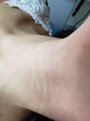 -爱莎扁平疣·汗管瘤·斑痣中心