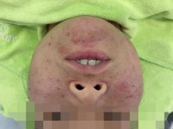 -苗医生0感科技祛痘