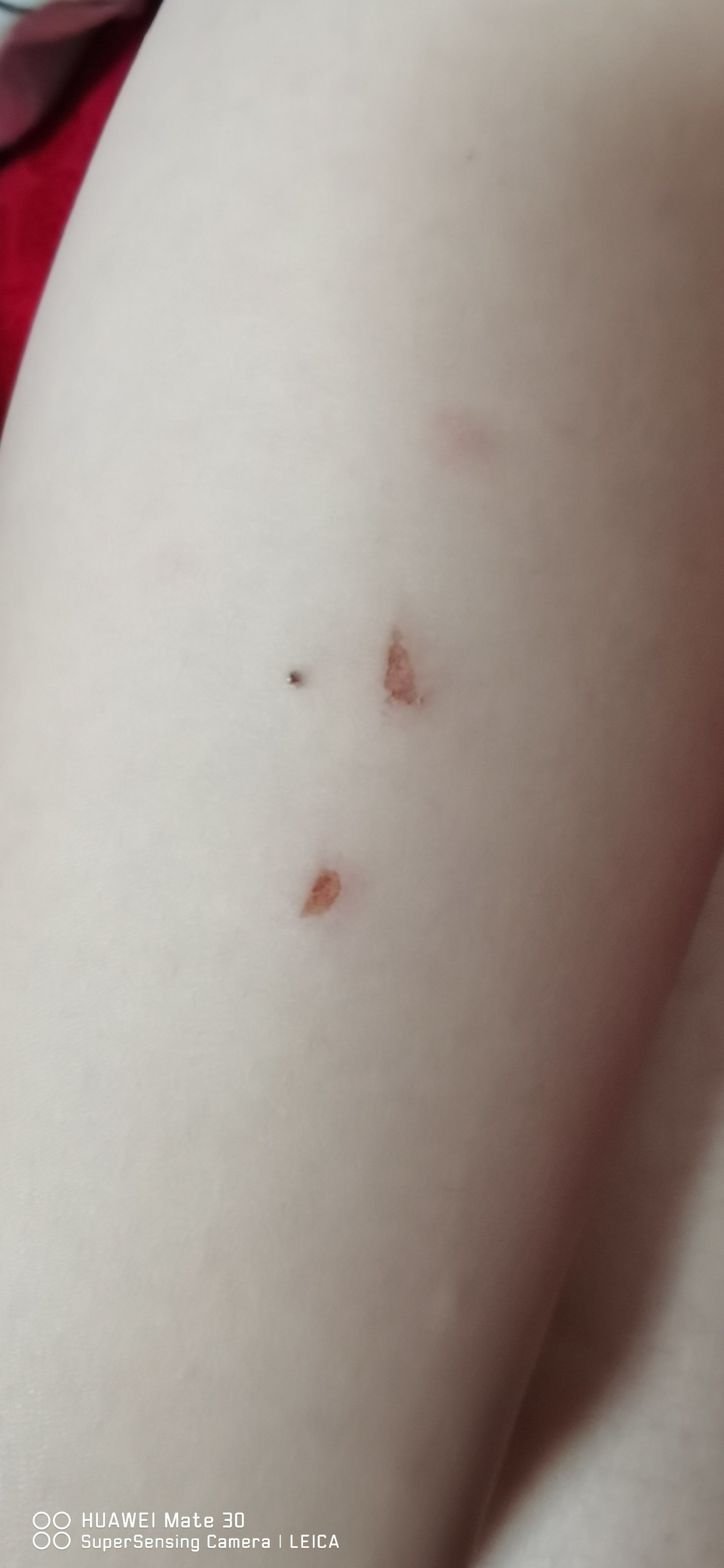 发现孩子在学校被人挠伤了