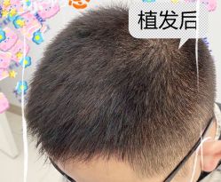 -大麦微针植发全国连锁