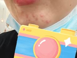 -悟空祛痘·诺奖技术专业店