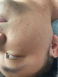 -爱莎扁平疣·汗管瘤·斑痣中心
