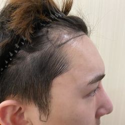 -碧莲盛·不剃发植发