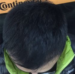 -碧莲盛·不剃发植发