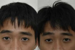 点击看大图 -广州健丽·去眼袋医疗美容机构