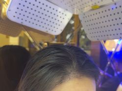 -碧莲盛·不剃发植发