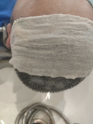 -碧莲盛·不剃发植发