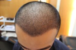 点击看大图 -大麦微针植发丨全国连锁