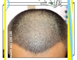 -大麦微针植发全国连锁