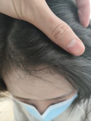 点击看大图 体验后-熙朵美学植发连锁