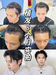 -大麦微针植发丨全国连锁