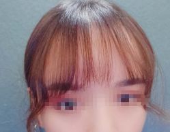 -大麦微针植发丨全国连锁