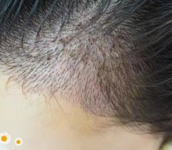 -大麦微针植发丨全国连锁