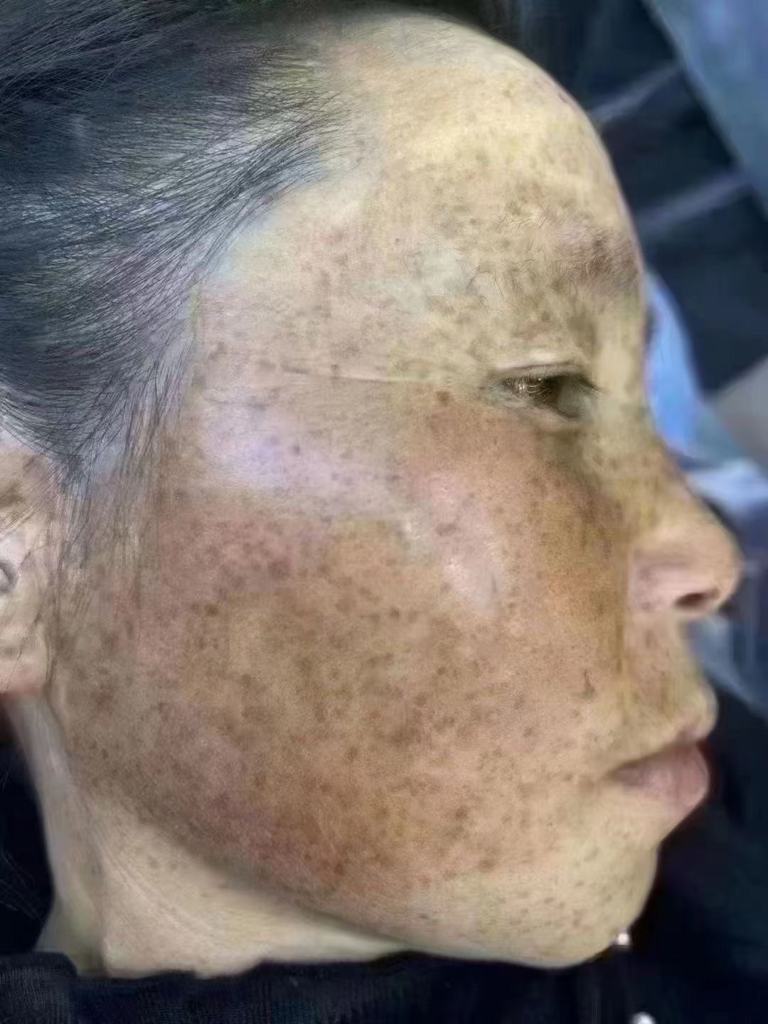 月累 则形成严重色斑
⚠所以有斑一定不要拖