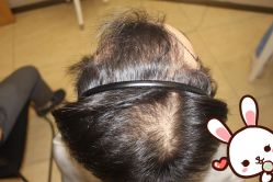 点击看大图 -大麦微针植发丨全国连锁