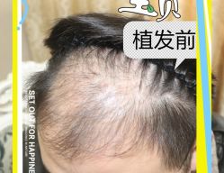 -大麦微针植发全国连锁