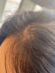 -碧莲盛·不剃发植发