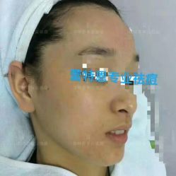 点击看大图 -蕾特恩专业祛痘