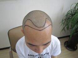 -大麦微针植发丨全国连锁