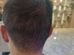 -碧莲盛·不剃发植发